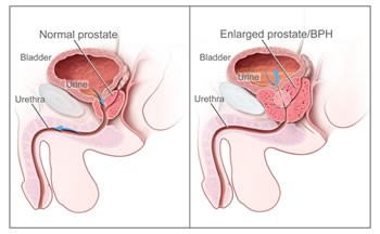 prostatitis a férfi veseben prostate cyst mri